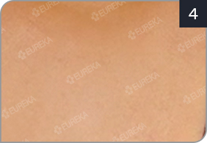 SST피부이식술 과정 이식된 피부에 색소생착 개선